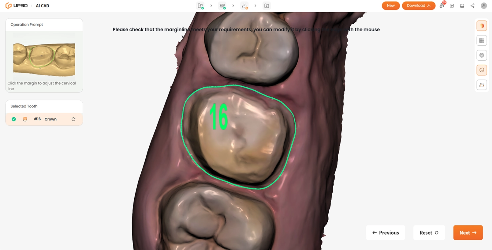 AI-powered margin line detection in UP3D AI CAD for accurate dental restoration design
